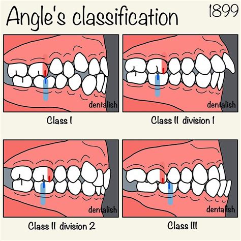 Dental prophy magic angle